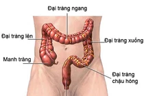 Dấu hiệu giúp phát hiện ung thư đại tràng