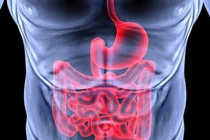 Những yếu tố hàng đầu gây ung thư đại tràng