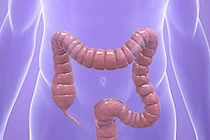 Những hiểu lầm thường gặp về ung thư đại tràng