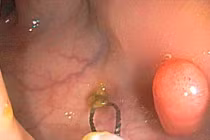 Phân biệt trĩ và ung thư đại tràng