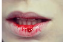 HPV tàn phá răng miệng khủng khiếp hơn cả thuốc lá