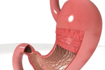 Những dấu hiệu sớm của bệnh ung thư dạ dày