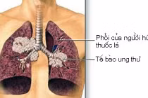 Bí quyết đơn giản giúp tránh xa ung thư phổi