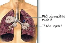 Bí quyết đơn giản giúp tránh xa ung thư phổi