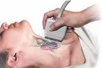 Nguyên nhân bạn mắc ung thư tuyến giáp thứ cấp