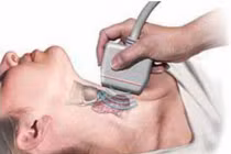 Nguyên nhân bạn mắc ung thư tuyến giáp thứ cấp