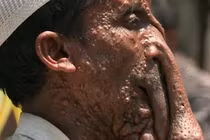 Nghịch cảnh người voi từ chối gương mặt đẹp để ăn xin