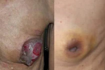 Biểu hiện lạ khi trai trẻ mắc ung thư vú