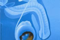 Dấu hiệu nhận biết sớm ung thư tinh hoàn