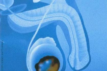 Dấu hiệu nhận biết sớm ung thư tinh hoàn