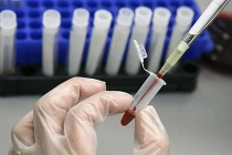 Các phương pháp chẩn đoán ung thư tinh hoàn