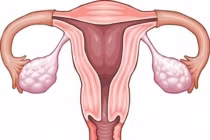 Các yếu tố hàng đầu gây ung thư buồng trứng