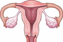 Các yếu tố hàng đầu gây ung thư buồng trứng