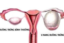 Sự khác biệt giữa ung thư buồng trứng và tử cung