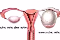 Sự khác biệt giữa ung thư buồng trứng và tử cung