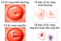 Cách dễ dàng phát hiện ung thư cổ tử cung