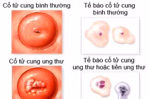 Cách dễ dàng phát hiện ung thư cổ tử cung