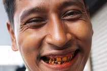 Tất tật điều cần biết về ung thư miệng