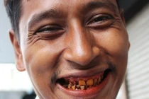 Tất tật điều cần biết về ung thư miệng