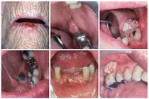 Cận cảnh sự tàn phá khủng khiếp của ung thư miệng