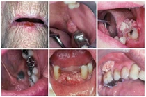 Cận cảnh sự tàn phá khủng khiếp của ung thư miệng