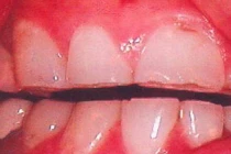 Điểm mặt những nguyên nhân gây ung thư miệng