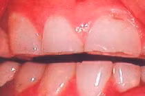 Điểm mặt những nguyên nhân gây ung thư miệng