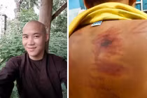 Thân thể bé trai 11 tuổi rướm máu, lở loét vì bị thầy chùa đánh đập dã man