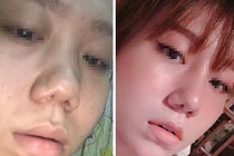 Vụ khách hàng tố Klain Beauty làm hỏng mũi: Công ty Klain dính phạt nhiều vi phạm