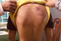 Bé trai 11 tuổi bị một người tu hành đánh dã man. Ảnh: Báo Pháp Luật TP HCM