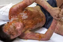 Tạt 5 lít axít vào chồng rồi bỏ trốn