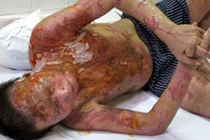 Tạt 5 lít axít vào chồng rồi bỏ trốn