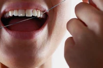 Niềng răng, căng thẳng... dễ gây các bệnh về lợi