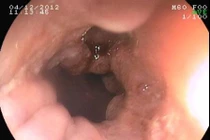 Nuốt nghẹn tức ngực, coi chừng ung thư thực quản