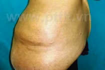 Cắt khối u lưng khổng lồ cho cô gái 24 tuổi