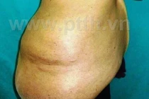 Cắt khối u lưng khổng lồ cho cô gái 24 tuổi