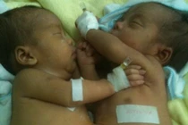 Bắt đầu tách cặp song sinh dính nhau ở Kon Tum
