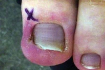 Đôi chân hay bị những căn bệnh nào nhất?