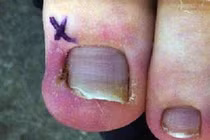 Đôi chân hay bị những căn bệnh nào nhất?