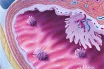 “Hung thủ” gây ung thư bàng quang ở chị em