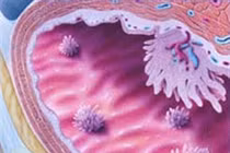 “Hung thủ” gây ung thư bàng quang ở chị em