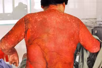 Hoại tử da toàn thân vì thực phẩm chức năng