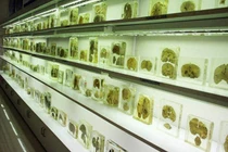 Rùng rợn bảo tàng não người ở Ấn Độ