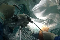 Điều trị liệt tủy sống bằng tế bào gốc