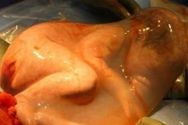 Cận cảnh ca sinh mổ thai nhi vẫn còn trong bọc nước