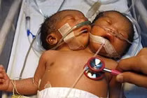 Lý giải hiện tượng trẻ có 2 đầu, 4 tay