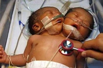 Lý giải hiện tượng trẻ có 2 đầu, 4 tay