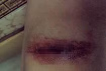 Cảnh báo “dùng dao lam dính máu HIV đi rạch đùi”?