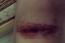 Cảnh báo “dùng dao lam dính máu HIV đi rạch đùi”?