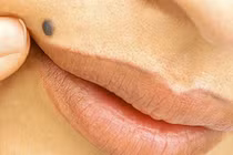 Ngứa nốt ruồi là ung thư?